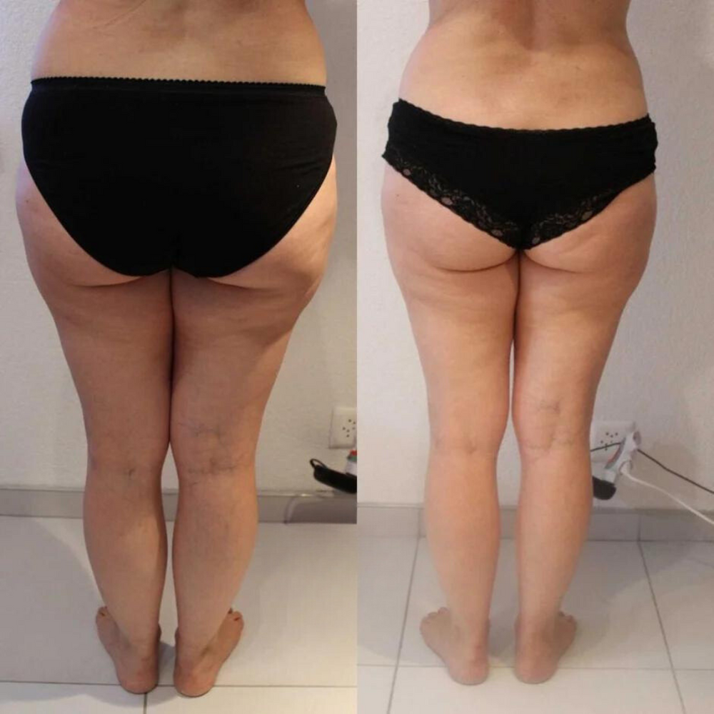 Resultat Maderotherapie 1
