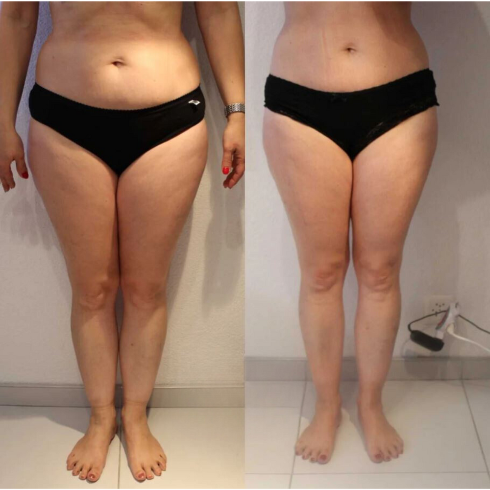 Resultat Maderotherapie 2