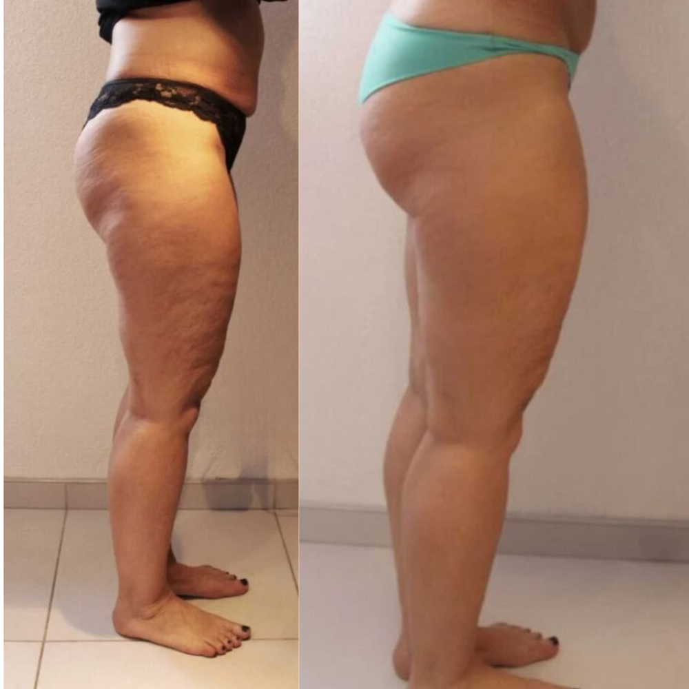 Resultat Maderotherapie 3