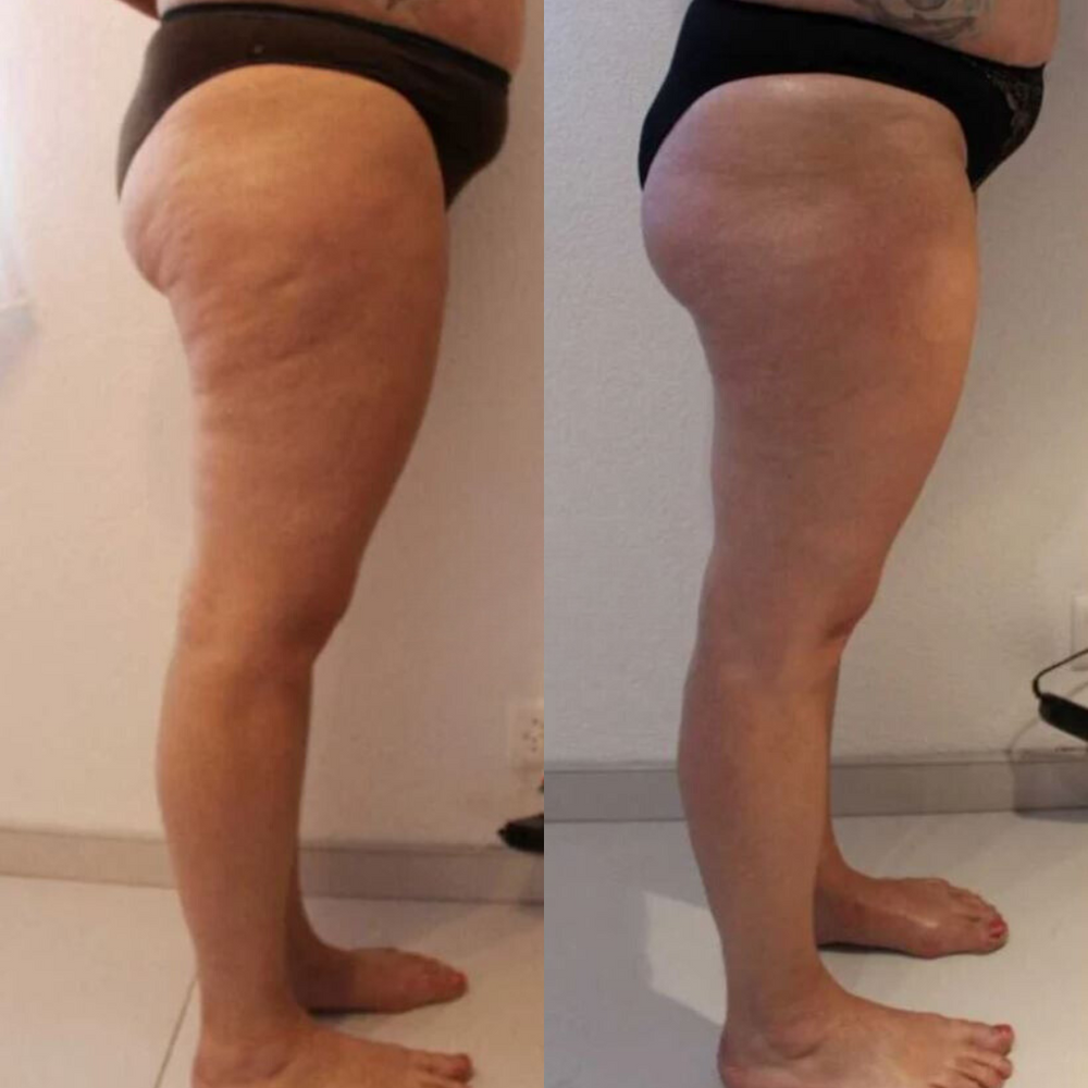 Resultat Maderotherapie 4