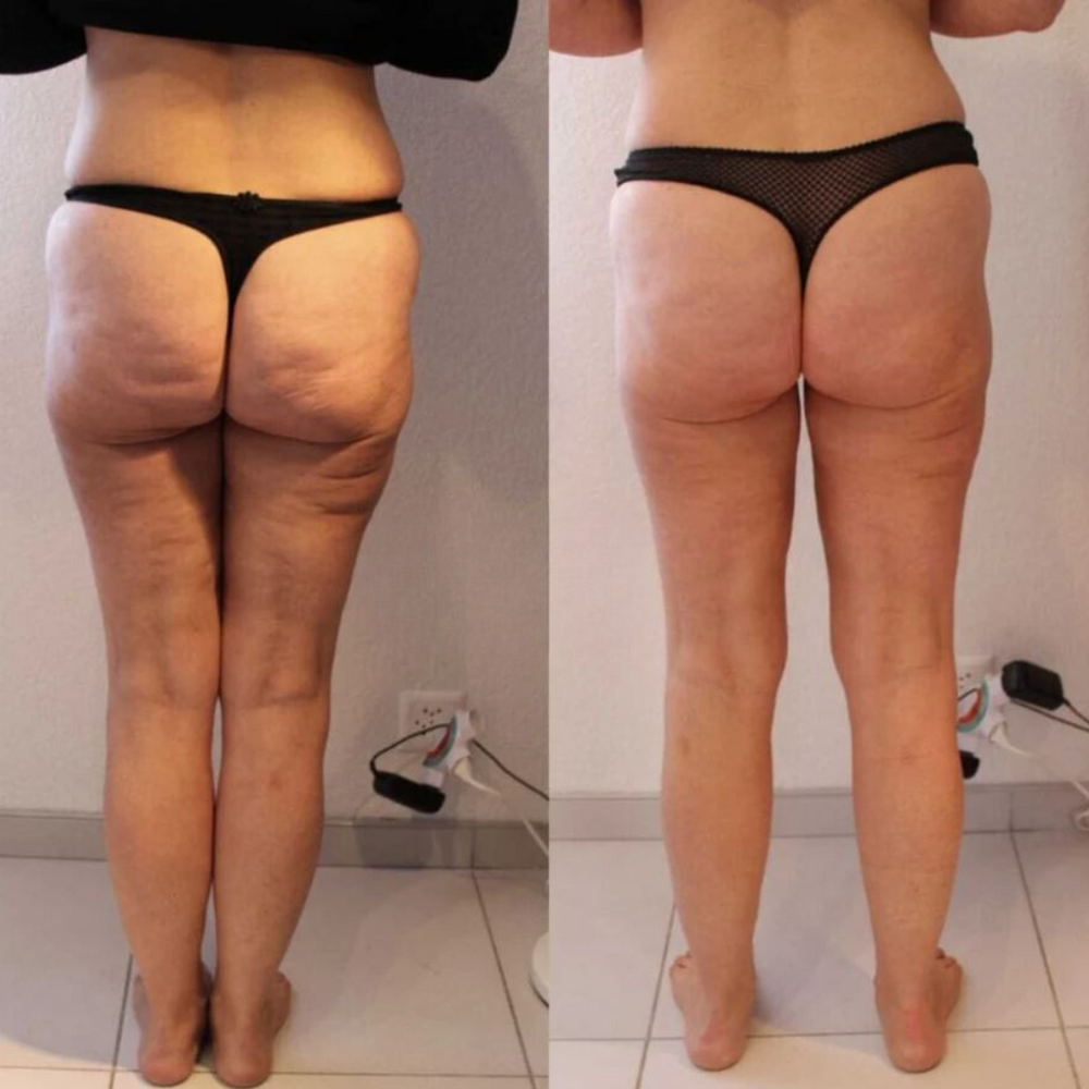 Resultat Maderotherapie 5